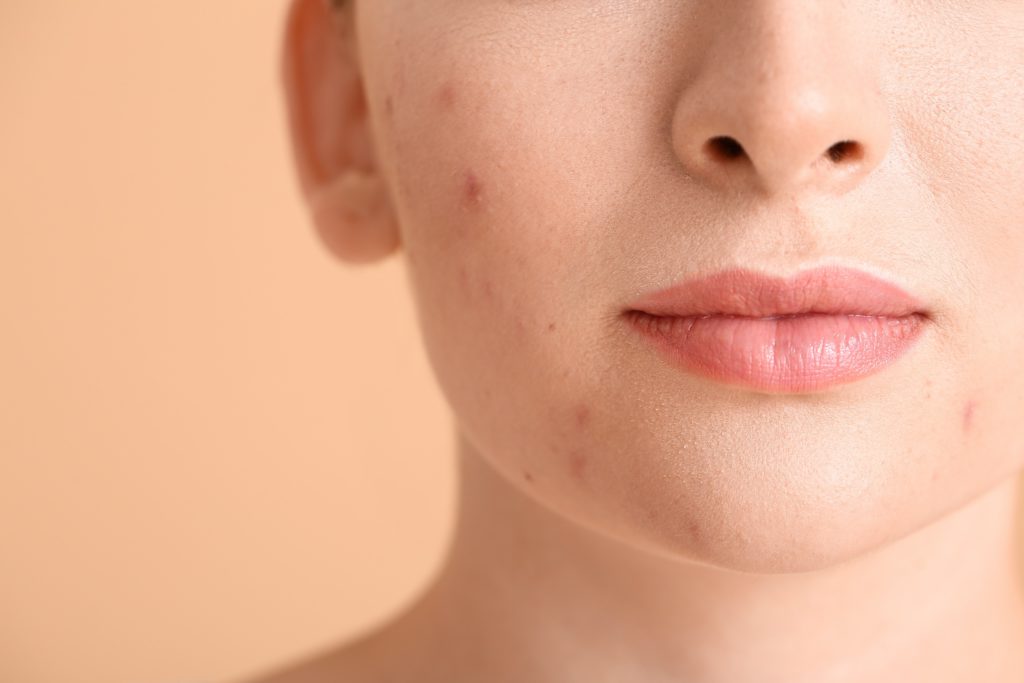 Acne veilig en effectief behandelen met licht – ZBC Multicare