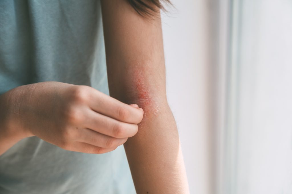 Eczeem veilig en effectief behandelen met licht – ZBC Multicare