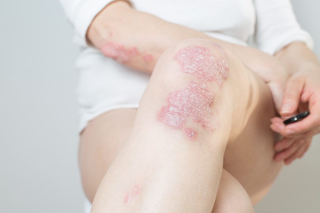 Heb je last van Psoriasis? – ZBC Multicare