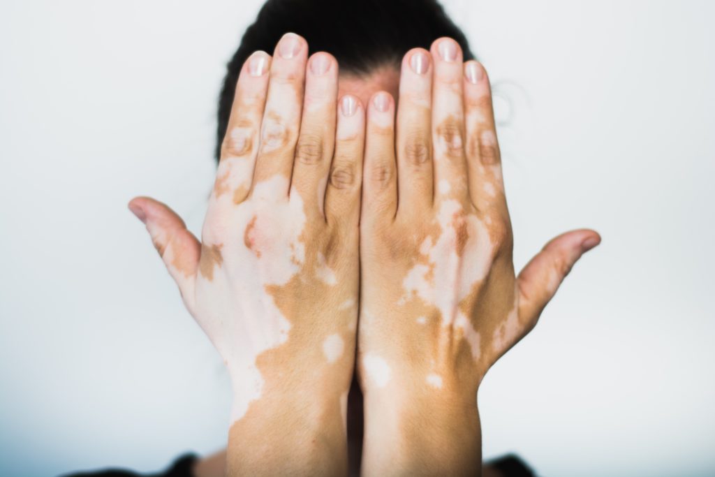 Behandel vitiligo veilig effectief met khelline ondersteunde UVB lichttherapie en blaardak transplantaties – ZBC Multicare